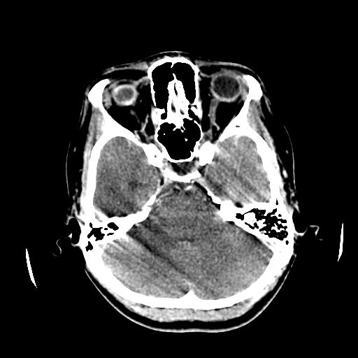 File:Choriocarcinoma of ovary with cerebral and pulmonary metastases (Radiopaedia 25983-26118 C+ arterial phase 42).jpg