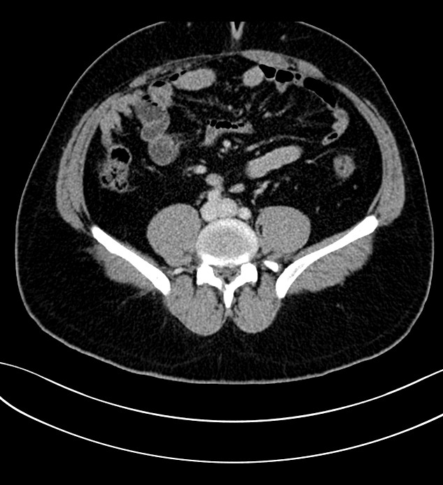 Chromophobe renal cell carcinoma (Radiopaedia 84286-99573 G 45).jpg