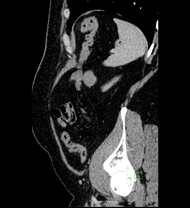 Chromophobe renal cell carcinoma (Radiopaedia 84286-99573 I 31).jpg