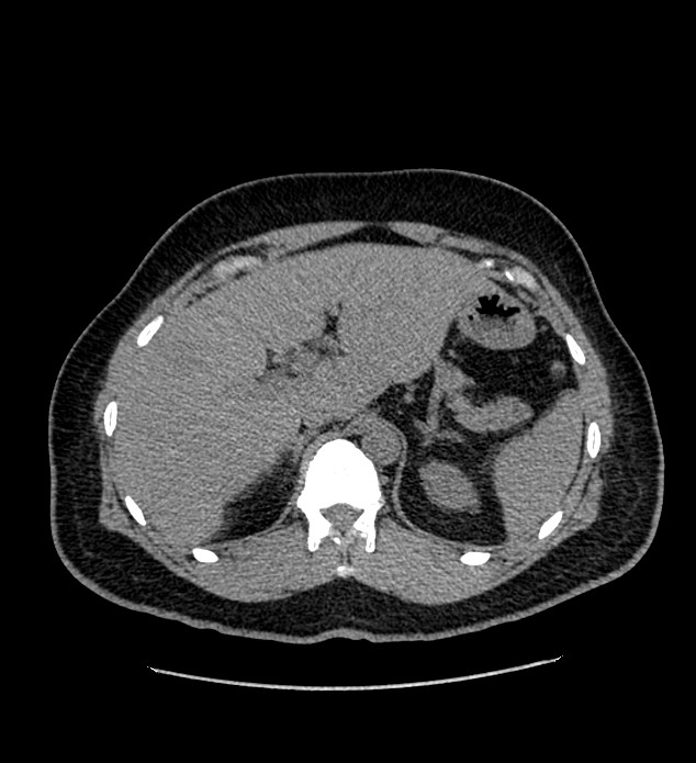 Chromophobe renal cell carcinoma (Radiopaedia 84337-99693 Axial non-contrast 29).jpg