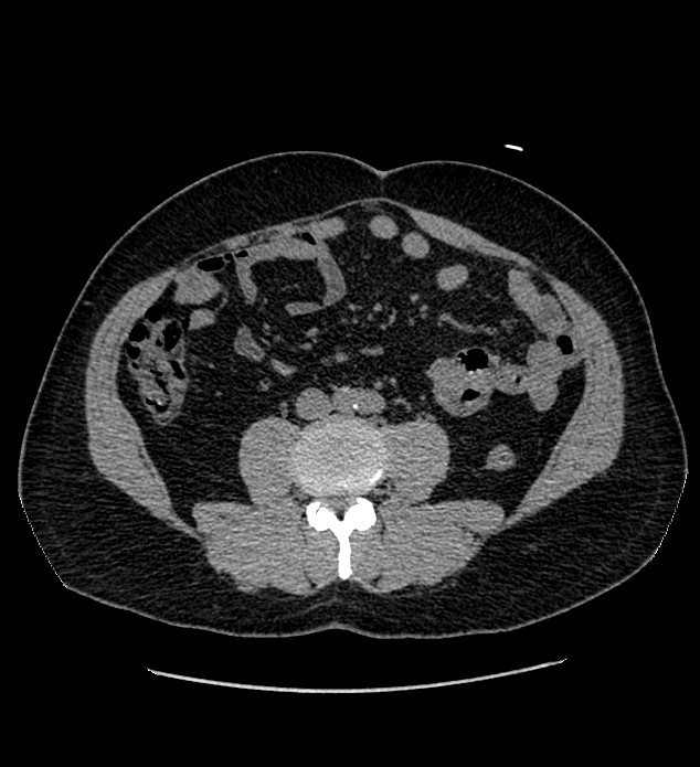 Chromophobe renal cell carcinoma (Radiopaedia 84337-99693 Axial non-contrast 85).jpg