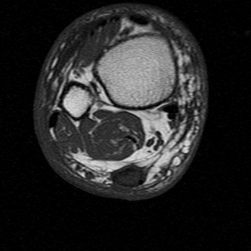 File:Chronic Achilles tendon rupture (Radiopaedia 15262-15100 Axial T1 5).jpg
