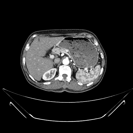 File:Chronic contained rupture of abdominal aortic aneurysm with extensive erosion of the vertebral bodies (Radiopaedia 55450-61901 A 6).jpg