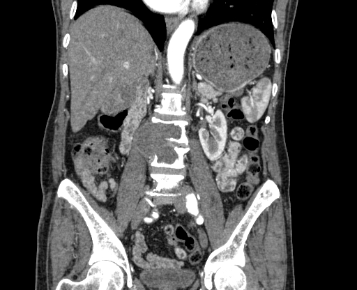 Chronic contained rupture of abdominal aortic aneurysm with extensive erosion of the vertebral bodies (Radiopaedia 55450-61901 D 42).jpg