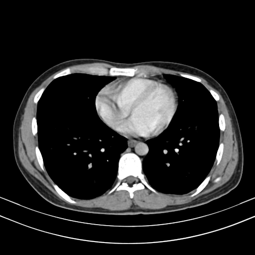 File:Chronic eosinophilic pneumonia (Radiopaedia 39331-41587 Axial C+ delayed 71).png