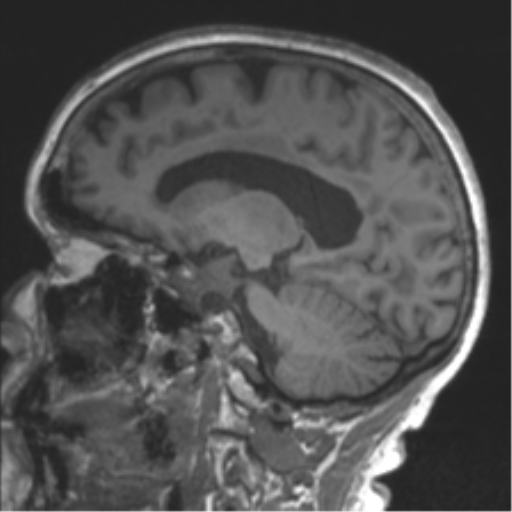 Chronic hypertensive encephalopathy (Radiopaedia 39993-42482 Sagittal T1 56).png