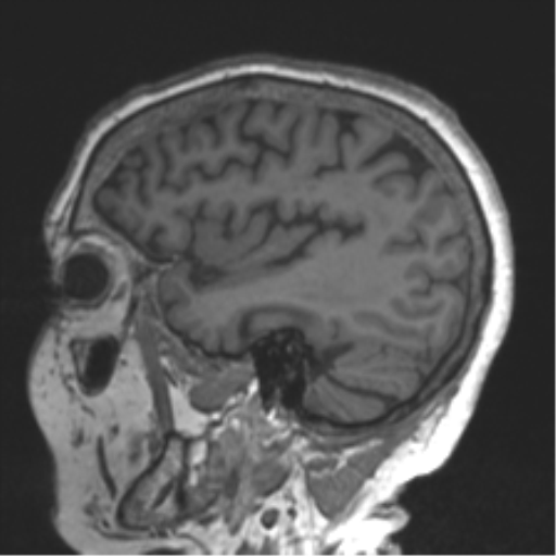 Chronic hypertensive encephalopathy (Radiopaedia 39993-42482 Sagittal T1 69).png