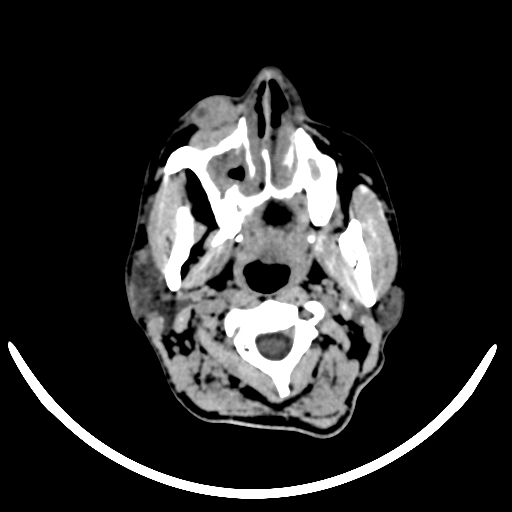 File:Chronic invasive fungal sinusitis with intraorbital and intracranial extension (Radiopaedia 56387-63046 Axial non-contrast 39).jpg