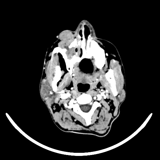 Chronic invasive fungal sinusitis with intraorbital and intracranial extension (Radiopaedia 56387-63046 B 10).jpg