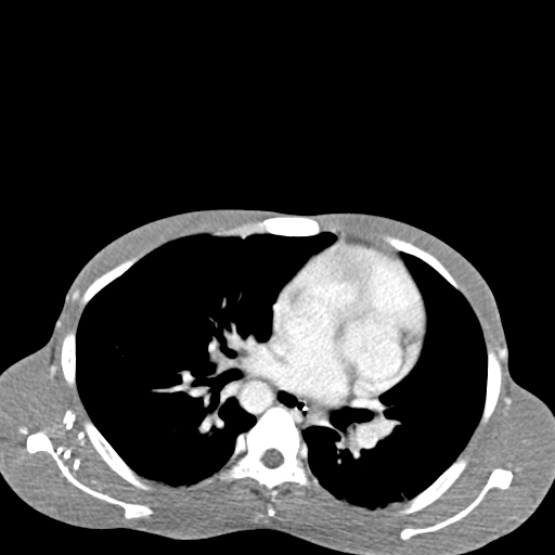 Chronic large bowel pseudo-obstruction (Radiopaedia 43181-46492 A 12).jpg