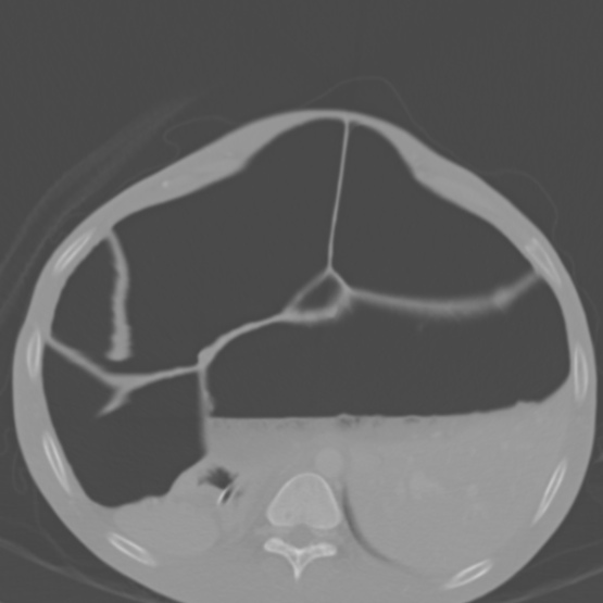 File:Chronic large bowel pseudo-obstruction (Radiopaedia 43181-46492 Axial bone window 52).jpg