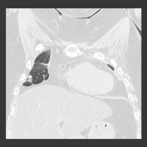 Chronic lung allograft dysfunction - restrictive form (Radiopaedia 60595-68316 Coronal lung window 32).jpg