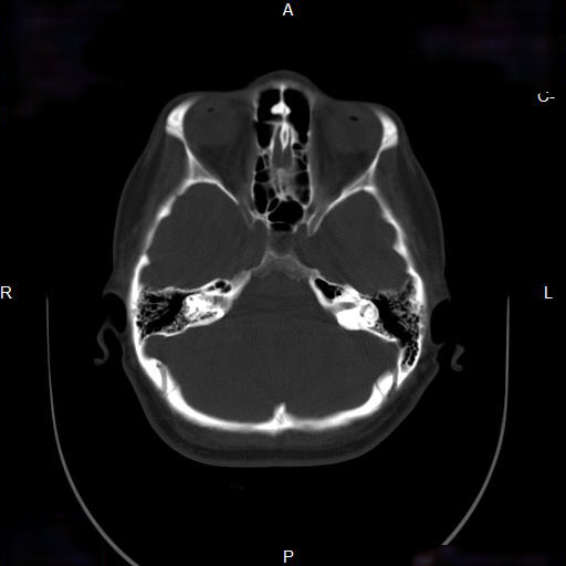File:Chronic maxillary sinusitis with a foreign body (dental filling material) (Radiopaedia 7811-8639 Axial bone window 12).jpg