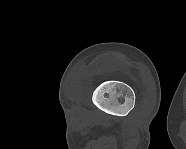Chronic ostemyelitis of the femur with long sinus tract (Radiopaedia 74947-85982 Axial bone window 182).jpg
