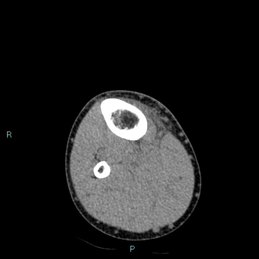 Chronic osteomyelitis (with Brodie abscess) (Radiopaedia 76405-88111 A 42).jpg