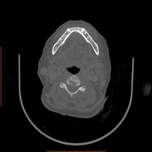 Chronic osteomyelitis - maxilla (Radiopaedia 23783-23927 Axial bone window 27).jpg