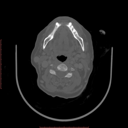 Chronic osteomyelitis - maxilla (Radiopaedia 23783-23927 Axial bone window 33).jpg