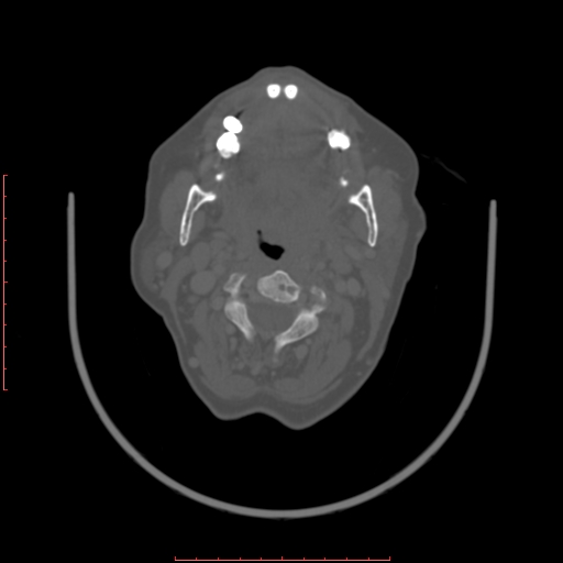Chronic osteomyelitis - maxilla (Radiopaedia 23783-23927 Axial bone window 55).jpg