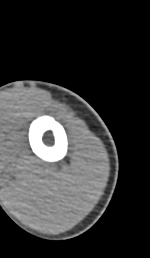 Chronic osteomyelitis of the distal humerus (Radiopaedia 78351-90971 Axial non-contrast 24).jpg