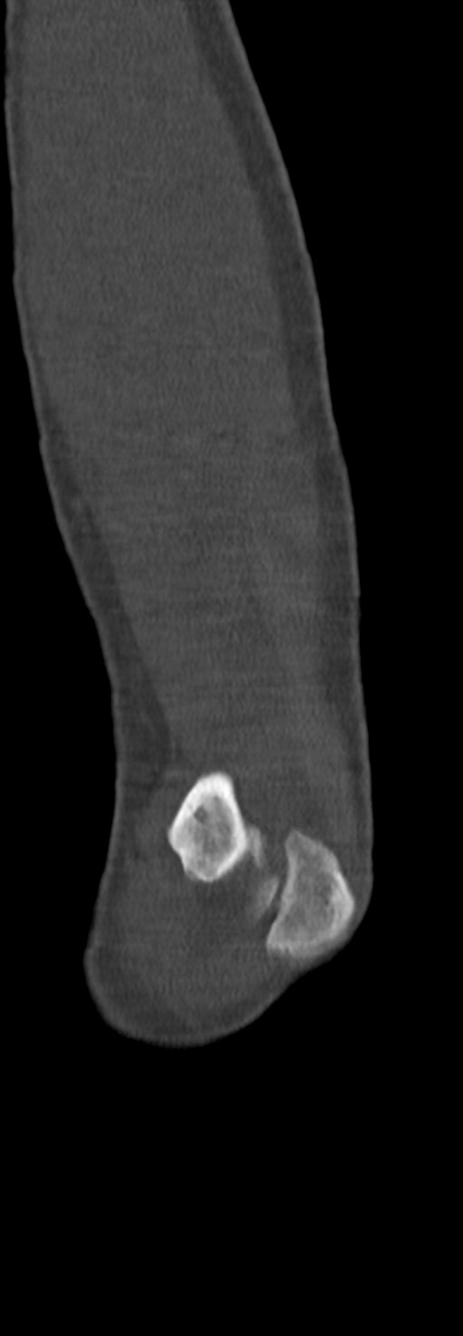Chronic osteomyelitis of the distal humerus (Radiopaedia 78351-90971 Sagittal bone window 62).jpg
