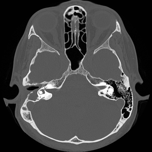 File:Chronic otomastoiditis (Radiopaedia 27138-27309 Axial bone window 37).jpg