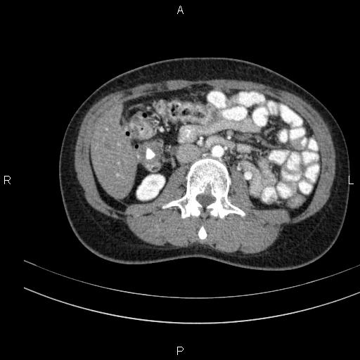 Chronic pancreatitis (Radiopaedia 64576-73450 B 81).jpg