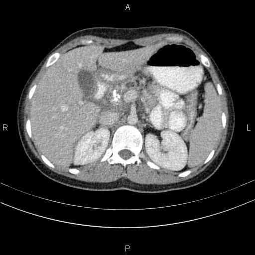 File:Chronic pancreatitis (Radiopaedia 64576-73450 C 41).jpg