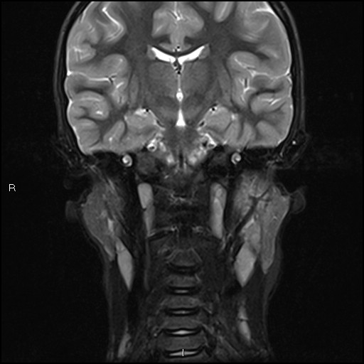 File:Chronic reactive multifocal osteomyelitis (CRMO) - mandible (Radiopaedia 56405-63069 Coronal STIR 22).jpg