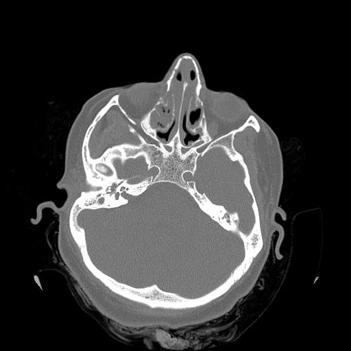 Chronic sinusitis with intra-sinus calcification (Radiopaedia 63919-72668 Axial bone window 29).jpg
