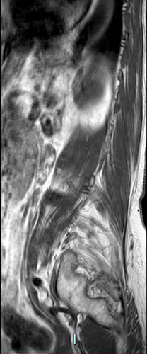 File:Chronic spinal hematoma with cauda equina syndrome (Radiopaedia 75745-87090 Sagittal T1 1).png