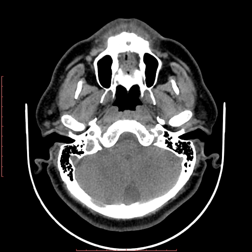 Chronic submandibular sialolithiasis (Radiopaedia 69817-79814 Axial non-contrast 19).jpg