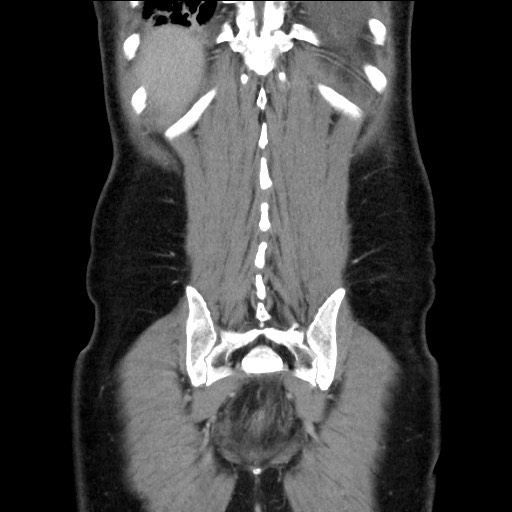 Chronic ureteropelvic junction obstruction (Radiopaedia 78365-90996 B 86).jpg