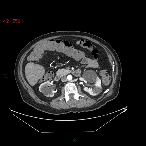 File:Circumaortic left renal vein and doubled left renal arteries (Radiopaedia 52268-58158 A 94).jpg