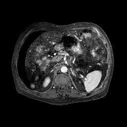 Cirrhosis and hepatocellular carcinoma in the setting of hemochromatosis (Radiopaedia 75394-86594 Axial T1 C+ fat sat 215).jpg