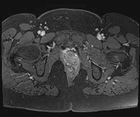 File:Class II Mullerian duct anomaly- unicornuate uterus with rudimentary horn and non-communicating cavity (Radiopaedia 39441-41755 Axial T1 fat sat 122).jpg