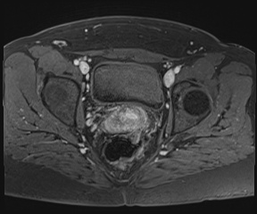 File:Class II Mullerian duct anomaly- unicornuate uterus with rudimentary horn and non-communicating cavity (Radiopaedia 39441-41755 Axial T1 fat sat 87).jpg