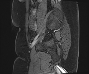 File:Class II Mullerian duct anomaly- unicornuate uterus with rudimentary horn and non-communicating cavity (Radiopaedia 39441-41755 G 6).jpg