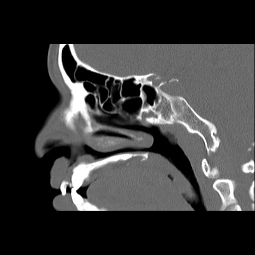 Cleft hard palate and alveolus (Radiopaedia 63180-71710 Sagittal bone window 29).jpg