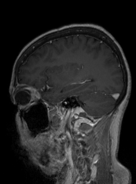 Clival meningioma (Radiopaedia 53278-59248 Sagittal T1 C+ 198).jpg