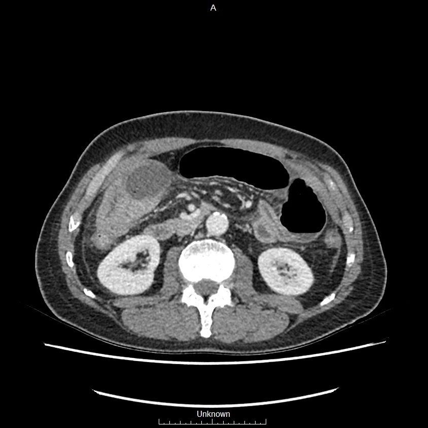 Closed loop bowel obstruction and ischemia (Radiopaedia 86959-103180 A 34).jpg