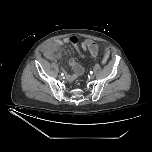 Closed loop obstruction due to adhesive band, resulting in small bowel ischemia and resection (Radiopaedia 83835-99023 B 119).jpg