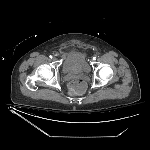 File:Closed loop obstruction due to adhesive band, resulting in small bowel ischemia and resection (Radiopaedia 83835-99023 B 144).jpg