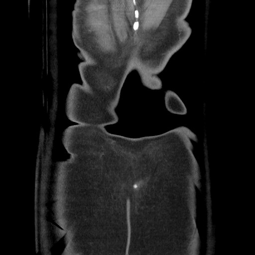 File:Closed loop obstruction due to adhesive band, resulting in small bowel ischemia and resection (Radiopaedia 83835-99023 C 120).jpg