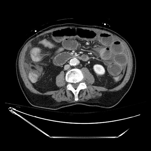 File:Closed loop obstruction due to adhesive band, resulting in small bowel ischemia and resection (Radiopaedia 83835-99023 D 81).jpg