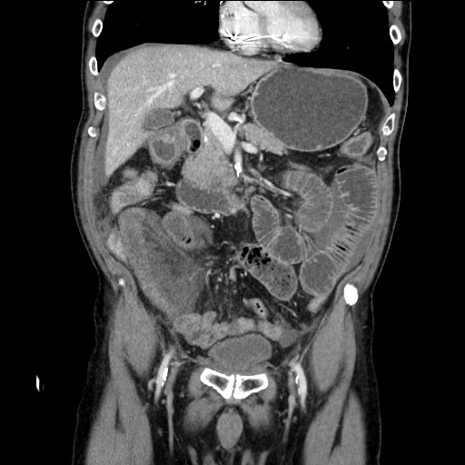 Closed loop obstruction due to adhesive band, resulting in small bowel ischemia and resection (Radiopaedia 83835-99023 E 53).jpg
