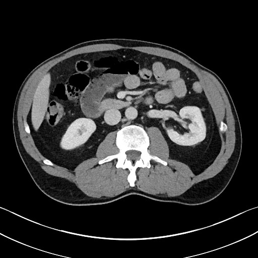Closed loop small bowel obstruction - internal hernia (Radiopaedia 57806-64778 B 54).jpg
