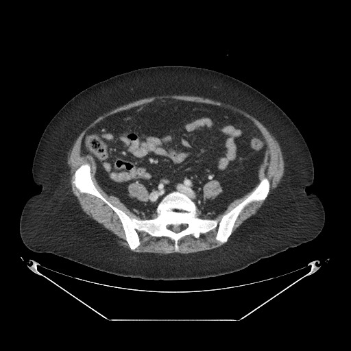 Closed loop small bowel obstruction - internal hernia (Radiopaedia 65402-74450 A 90).jpg