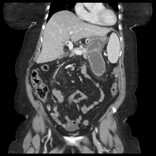 Closed loop small bowel obstruction - internal hernia (Radiopaedia 65402-74450 B 44).jpg