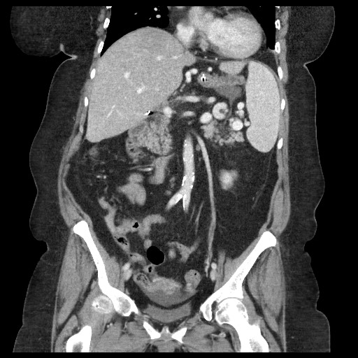 Closed loop small bowel obstruction - internal hernia (Radiopaedia 65402-74450 B 56).jpg