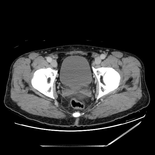 Closed loop small bowel obstruction - omental adhesion causing "internal hernia" (Radiopaedia 85129-100682 A 158).jpg